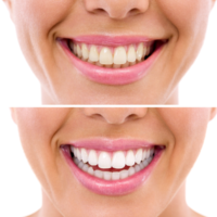 Tandblekning Dental Strips (10-pack)