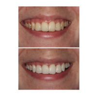 Tandblekning Dental Strips (10-pack)